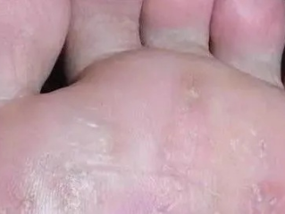 脚底长了像水泡一样的东西很痒是什么原因（脚底长了像水泡一样的东西很痒是什么原因）