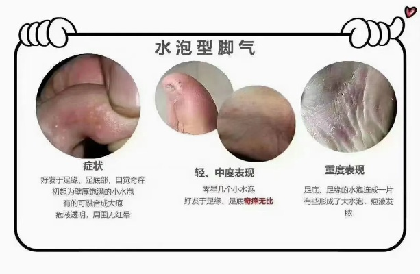 脚上怎么分辨是湿疹还是脚气，一份清晰实用的鉴别指南